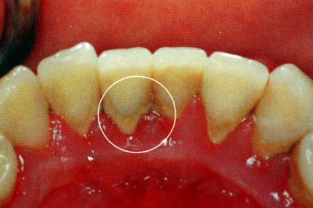 牙齿突然掉了一块是为什么?