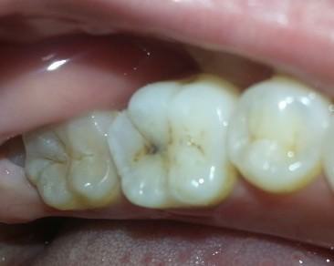 针眼大小的龋洞需要补吗?