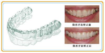 正夫无托槽隐形矫正--让牙齿“悄然”立正