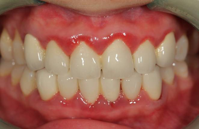 【牙周炎案例】从此再也不用忍受牙周炎困扰了!