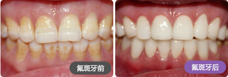 技术特点 典型的氟斑牙,四环素牙,经过正夫数字化美学超薄牙贴面修复